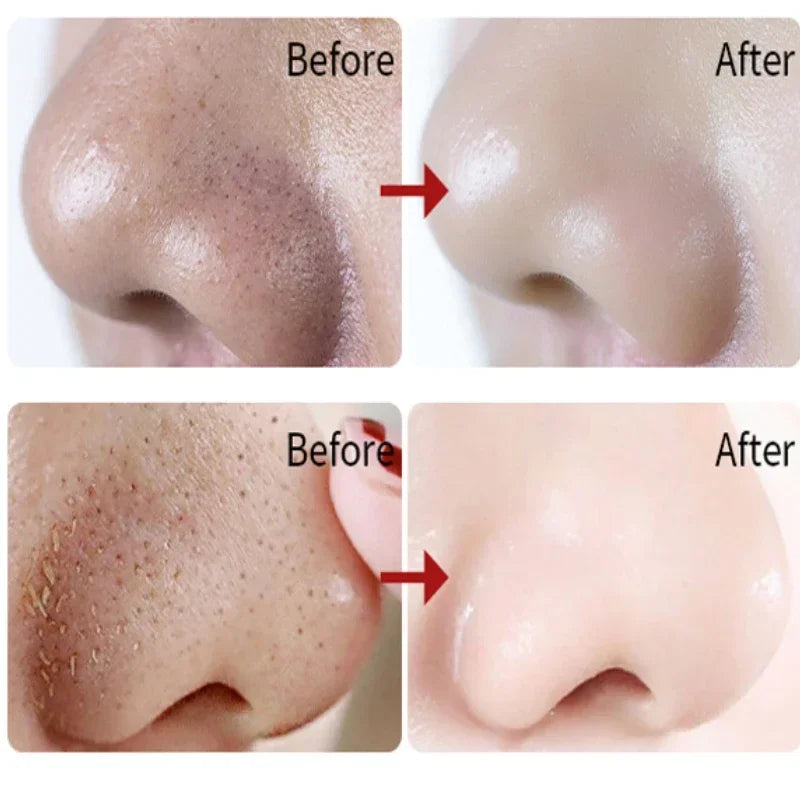 Blackhead Remover Mask